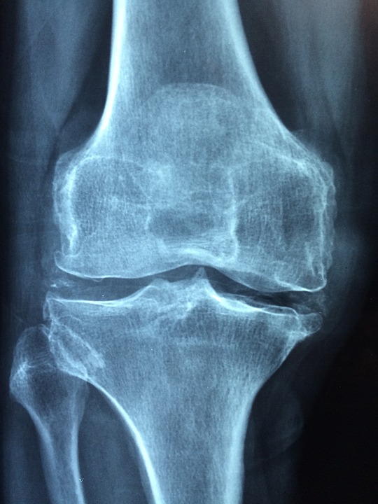 total knee replacement